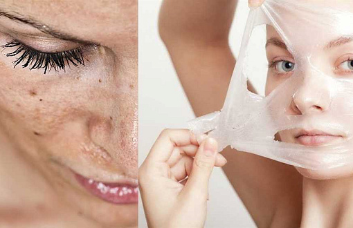 5 методов, которые помогут избавиться от возрастных сухих пятен на коже лица